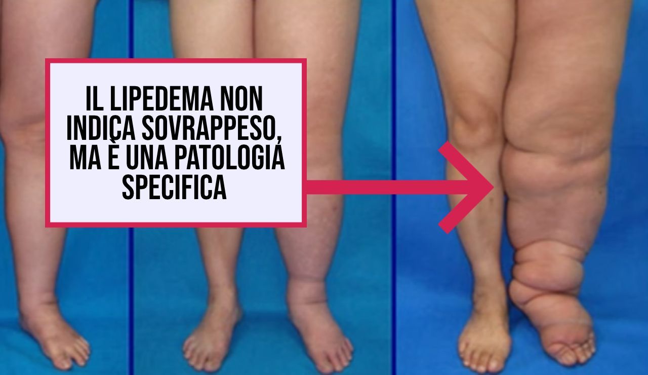 la-nuova-tecnica-non-invasiva-per-contrastare-le-gambe-gonfie-determinate-dal-lipedema